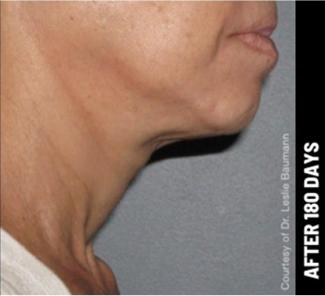 Ultherapy Before & After Patient #1555